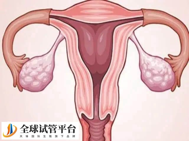 内膜异位试管的优缺点是什么