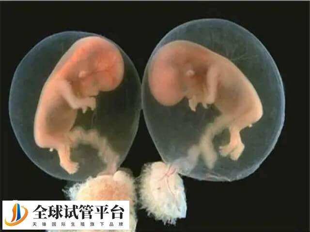 做试管婴儿生双胞胎的概率有多高