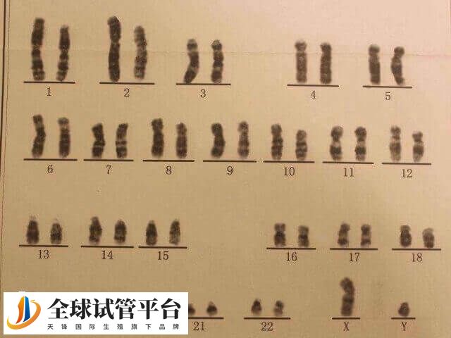 5号染色体三体是什么意思