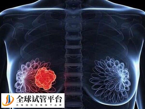 女性乳腺癌是怎么引起的原因