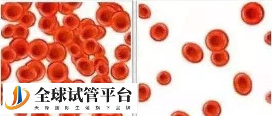 缺铁性贫血