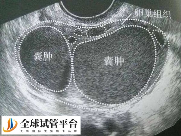 巧囊是手术还是直接试管