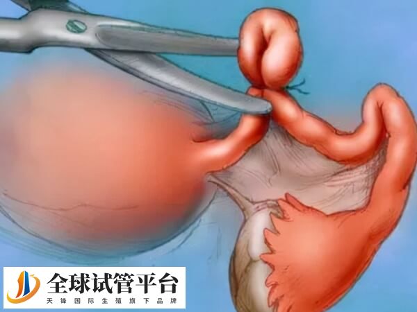 结扎后可以做试管婴儿